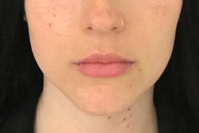 Dermal Fillers Before & After Gallery - Patient 161870 - Image 2