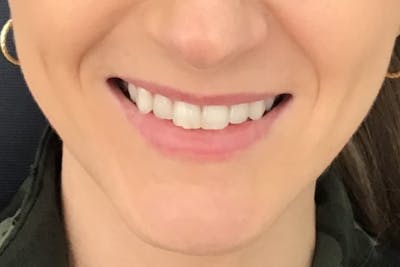 Dermal Fillers Before & After Gallery - Patient 429312 - Image 1