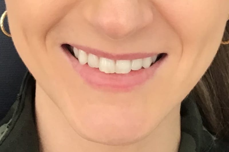 Dermal Fillers Before & After Gallery - Patient 429312 - Image 1