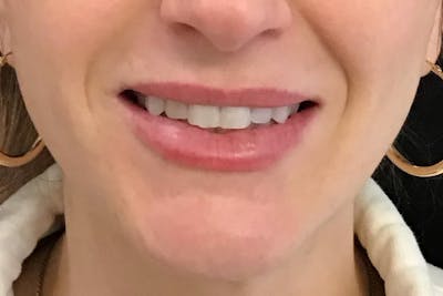 Dermal Fillers Before & After Gallery - Patient 429312 - Image 2