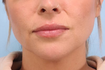 Dermal Fillers Before & After Gallery - Patient 116800 - Image 1
