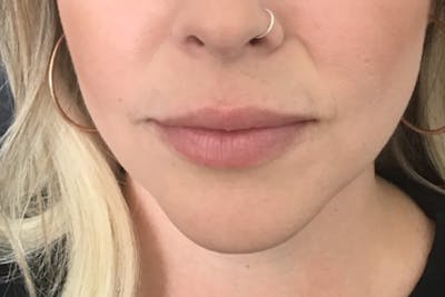 Dermal Fillers Before & After Gallery - Patient 116800 - Image 2