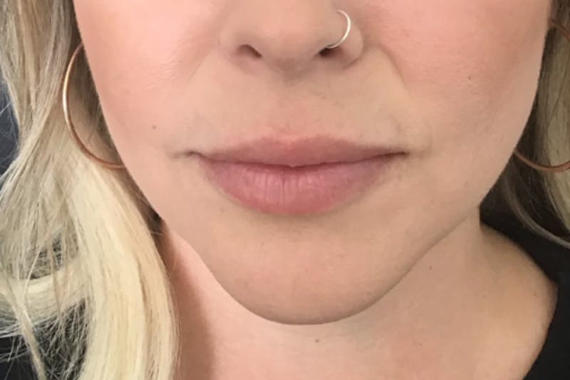 Dermal Fillers Before & After Gallery - Patient 116800 - Image 2