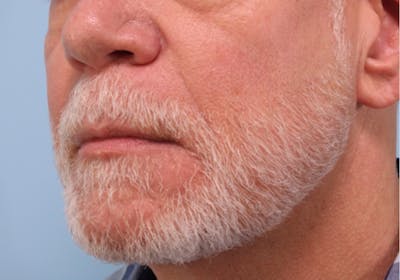 Dermal Fillers Before & After Gallery - Patient 360752 - Image 1