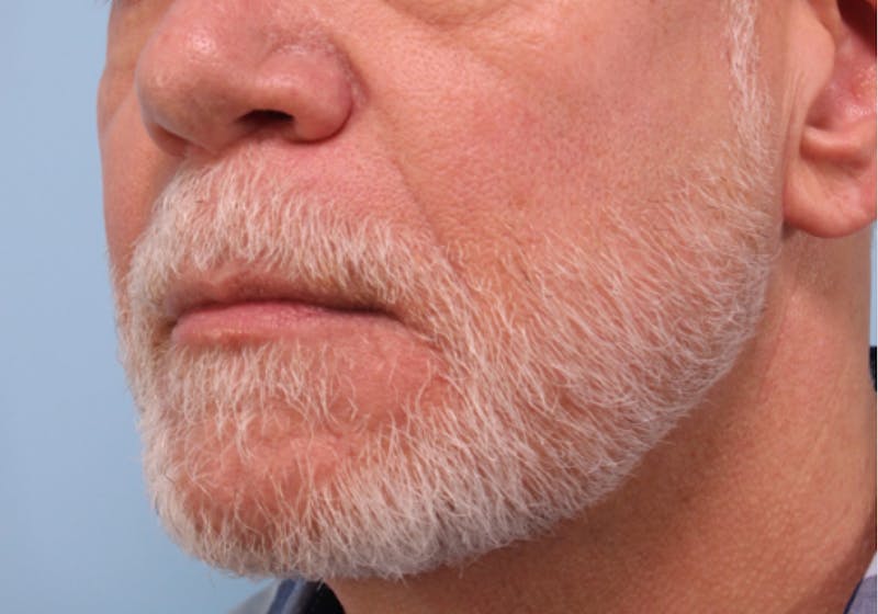 Dermal Fillers Before & After Gallery - Patient 360752 - Image 1