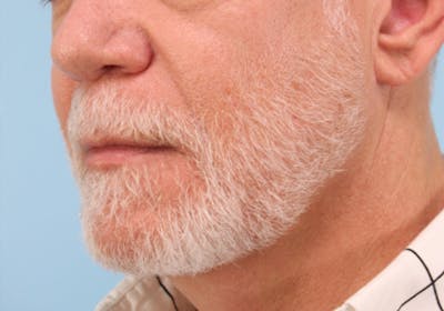 Dermal Fillers Before & After Gallery - Patient 360752 - Image 2