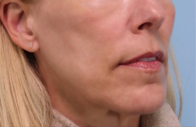 Dermal Fillers Before & After Gallery - Patient 197556 - Image 1