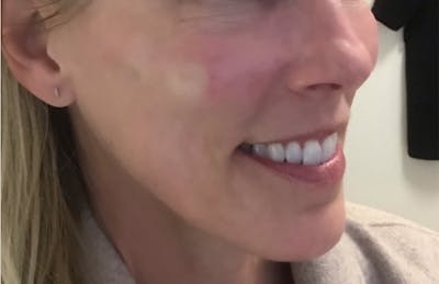 Dermal Fillers Before & After Gallery - Patient 197556 - Image 2