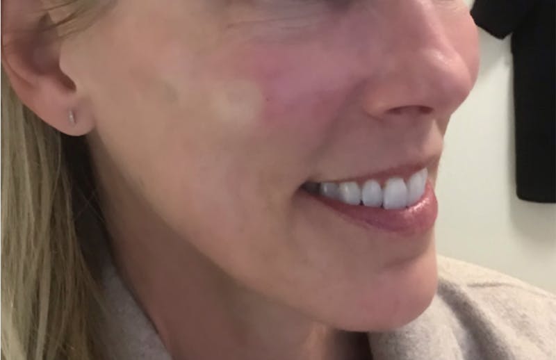 Dermal Fillers Before & After Gallery - Patient 197556 - Image 2