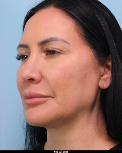 Dermal Fillers Before & After Gallery - Patient 594831 - Image 2