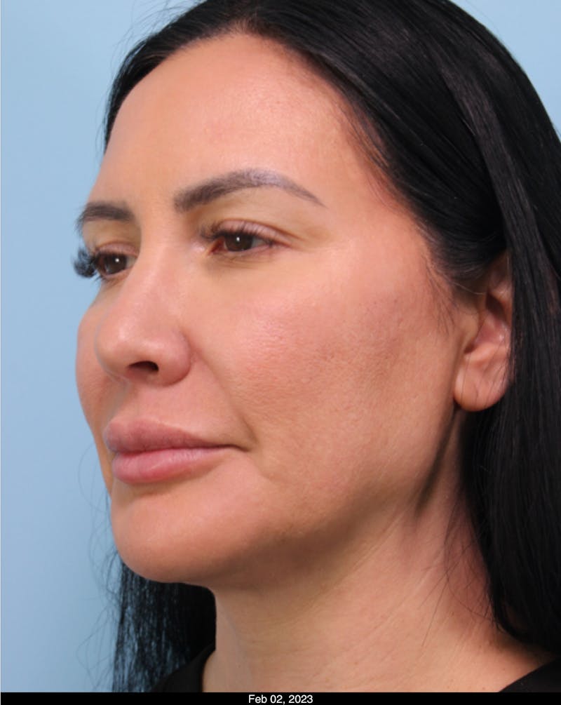 Dermal Fillers Before & After Gallery - Patient 594831 - Image 2