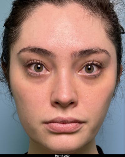 Dermal Fillers Before & After Gallery - Patient 330022 - Image 1