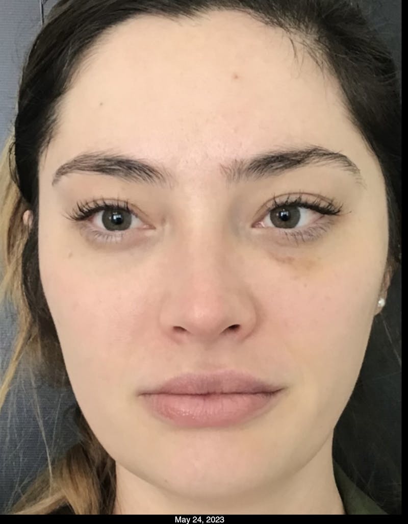 Dermal Fillers Before & After Gallery - Patient 330022 - Image 2