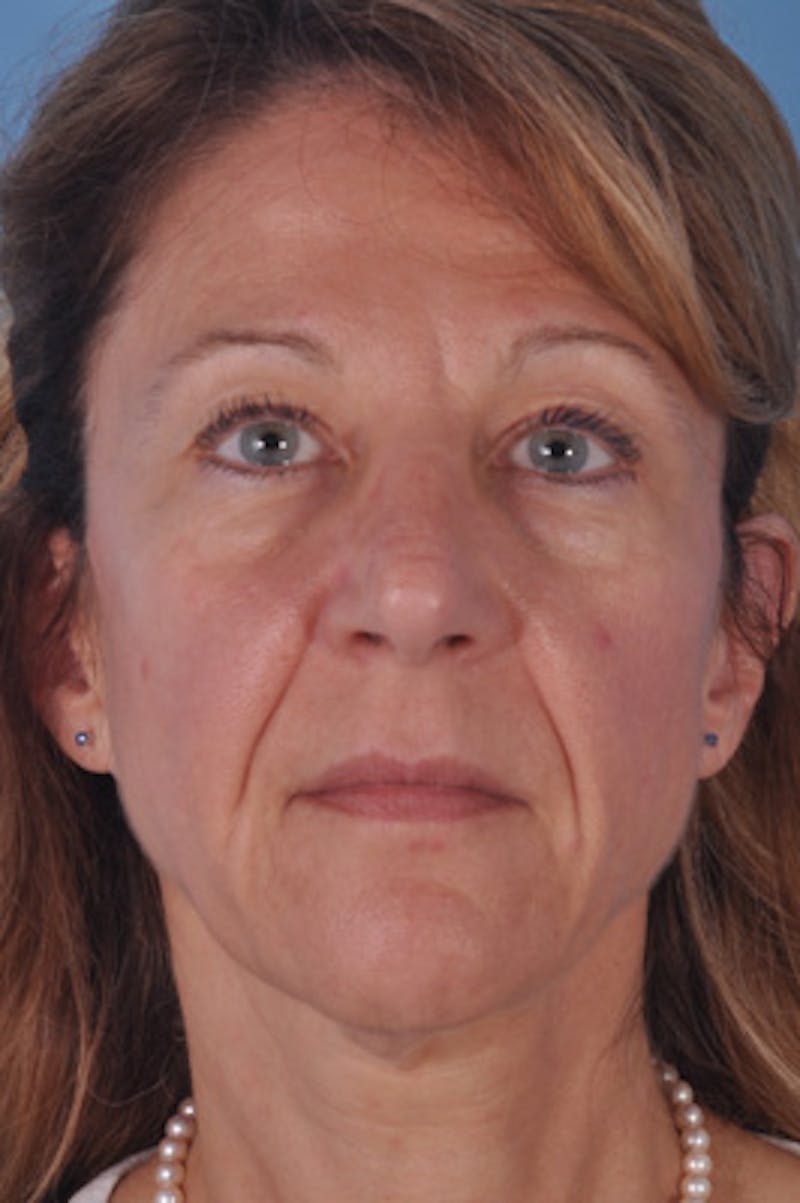 Dermal Fillers Before & After Gallery - Patient 481407 - Image 1