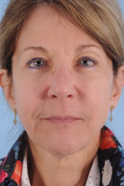 Dermal Fillers Before & After Gallery - Patient 481407 - Image 2