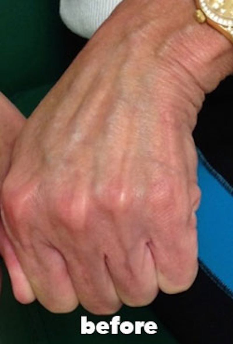 Dermal Fillers Before & After Gallery - Patient 334209 - Image 1