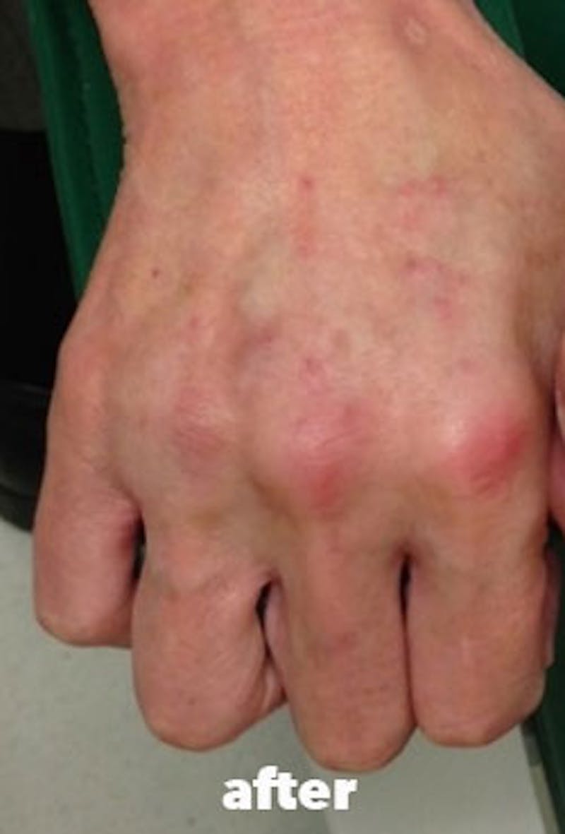 Dermal Fillers Before & After Gallery - Patient 334209 - Image 2