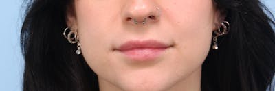 Dermal Fillers Before & After Gallery - Patient 152867 - Image 2