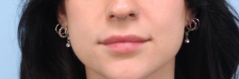 Dermal Fillers Before & After Gallery - Patient 152867 - Image 2