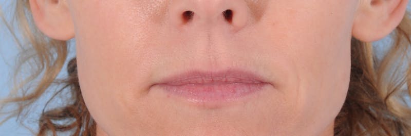 Dermal Fillers Before & After Gallery - Patient 332182 - Image 1