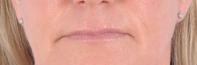 Dermal Fillers Before & After Gallery - Patient 161693 - Image 1