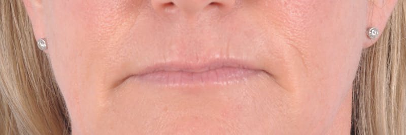 Dermal Fillers Before & After Gallery - Patient 161693 - Image 1