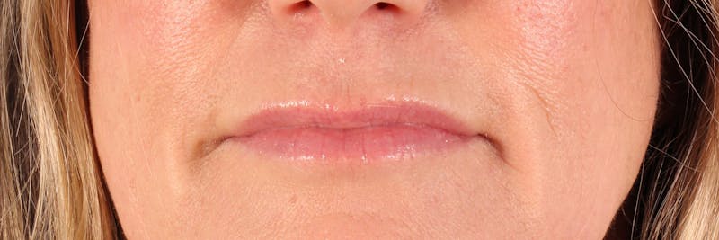 Dermal Fillers Before & After Gallery - Patient 161693 - Image 2