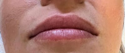 Dermal Fillers Before & After Gallery - Patient 293457 - Image 1