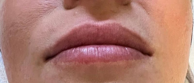 Dermal Fillers Before & After Gallery - Patient 293457 - Image 1