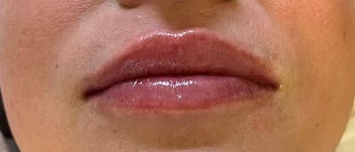 Dermal Fillers Before & After Gallery - Patient 293457 - Image 2