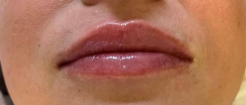 Dermal Fillers Before & After Gallery - Patient 293457 - Image 2