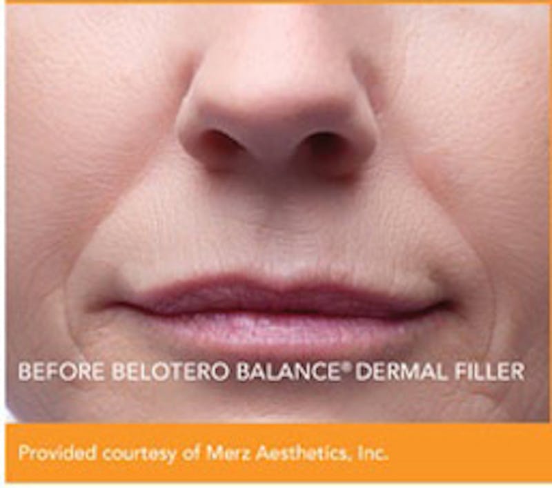 Dermal Fillers Before & After Gallery - Patient 390344 - Image 1
