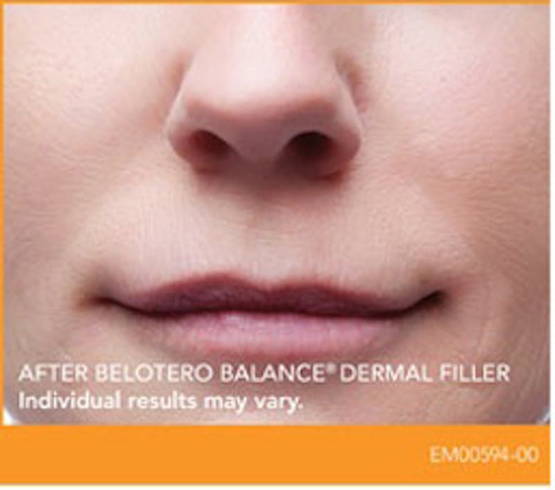 Dermal Fillers Before & After Gallery - Patient 390344 - Image 2