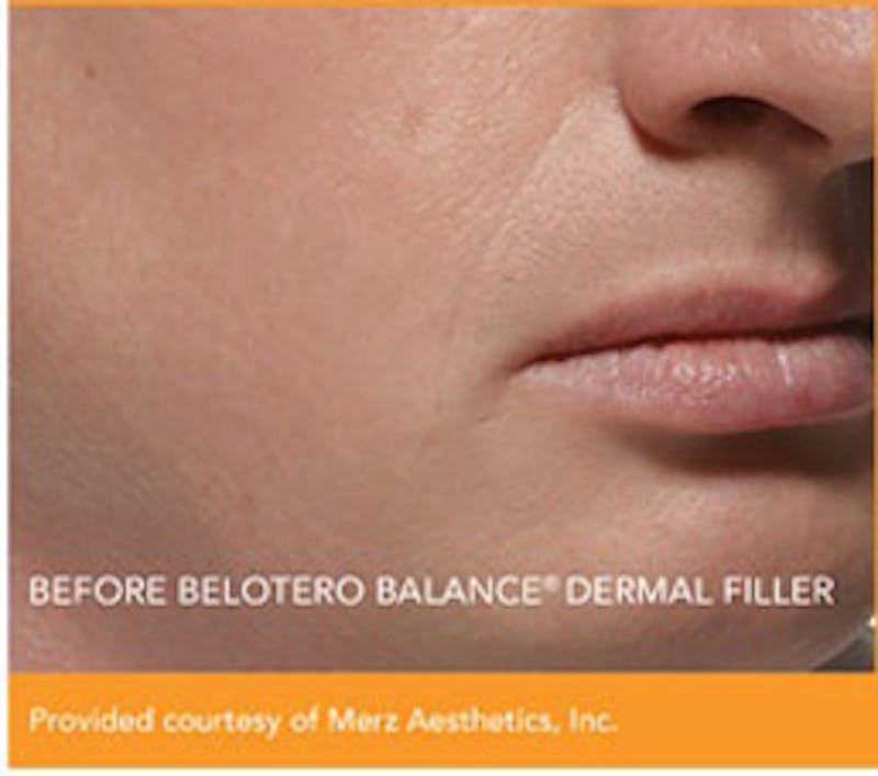 Dermal Fillers Before & After Gallery - Patient 113299 - Image 1