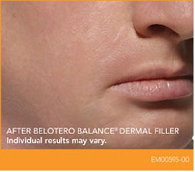 Dermal Fillers Before & After Gallery - Patient 113299 - Image 2