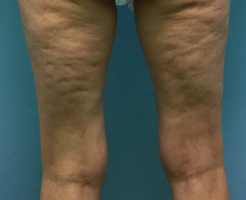 Kybella Before & After Gallery - Patient 175390 - Image 1