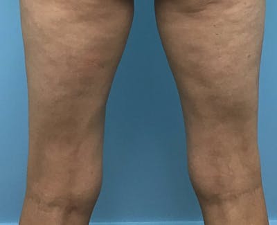 Kybella Before & After Gallery - Patient 175390 - Image 2