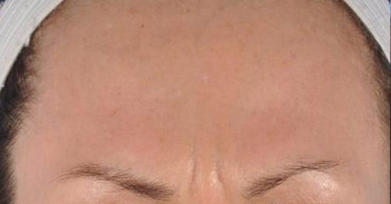Neurotoxins Before & After Gallery - Patient 277105 - Image 1