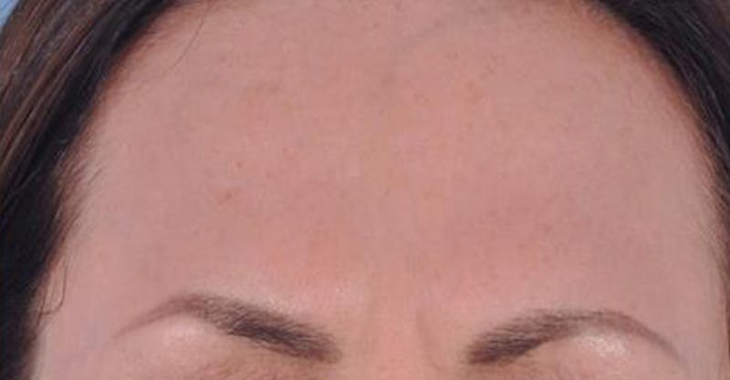 Neurotoxins Before & After Gallery - Patient 277105 - Image 2