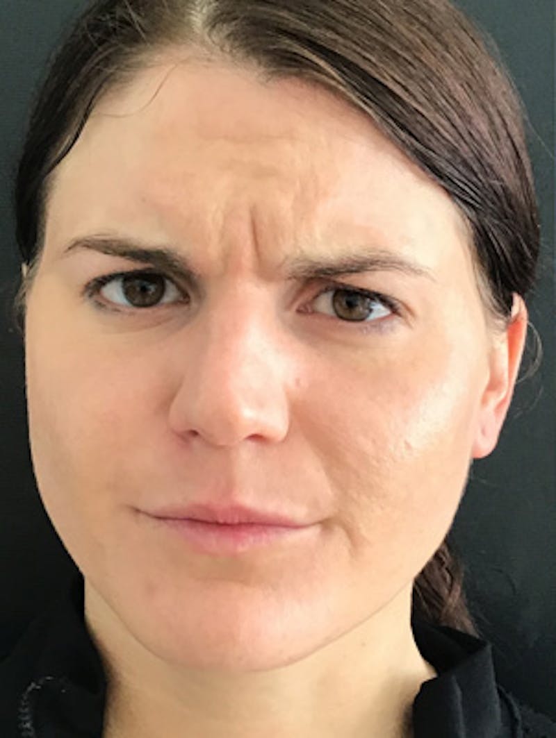 Neurotoxins Before & After Gallery - Patient 275401 - Image 1