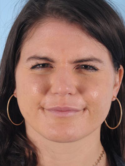 Neurotoxins Before & After Gallery - Patient 275401 - Image 2