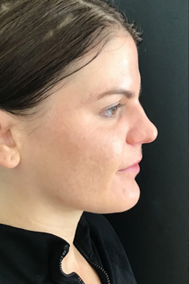 Neurotoxins Before & After Gallery - Patient 275401 - Image 3