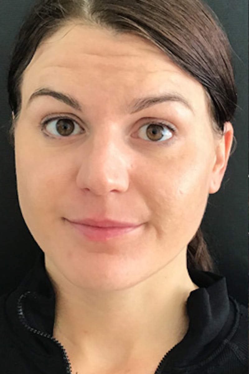 Neurotoxins Before & After Gallery - Patient 275401 - Image 5