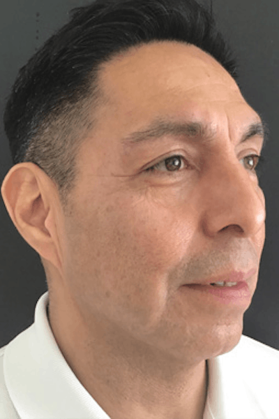 Neurotoxins Before & After Gallery - Patient 141180 - Image 1