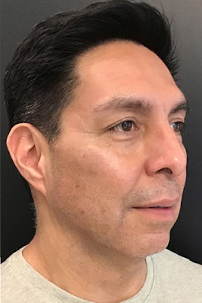 Neurotoxins Before & After Gallery - Patient 141180 - Image 2