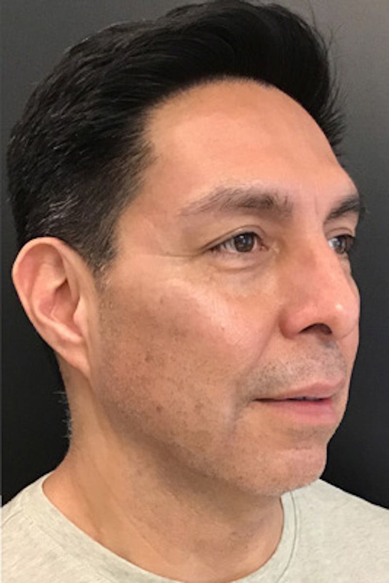 Neurotoxins Before & After Gallery - Patient 141180 - Image 2