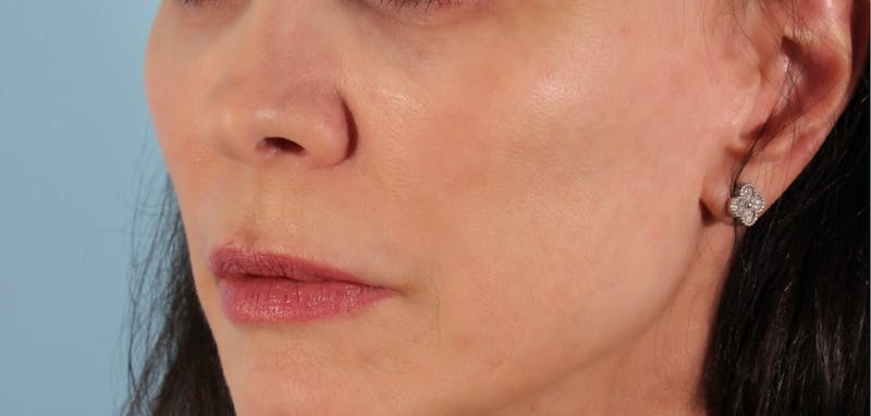 SKINVIVE Before & After Gallery - Patient 251766 - Image 1