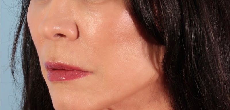 SKINVIVE Before & After Gallery - Patient 251766 - Image 2