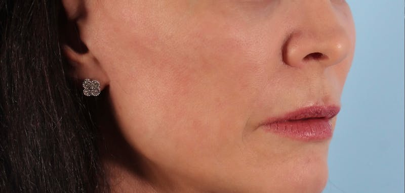 SKINVIVE Before & After Gallery - Patient 251766 - Image 3