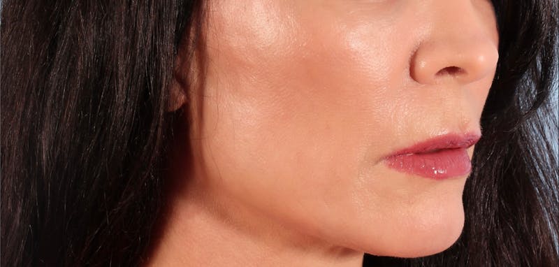 SKINVIVE Before & After Gallery - Patient 251766 - Image 4